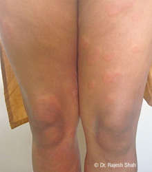 Urticaria on Legs